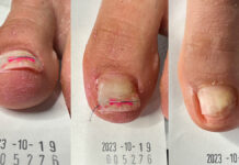 Paznokcie wkręcające. Studium przypadku