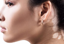 Poczucie własnej wartości u osób z bielactwem nabytym. Badanie ankietowe