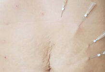 Techniki łączone w terapii rozstępów