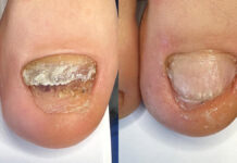 Paznokcie uszkodzone mechanicznie – studium przypadku