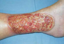 Rola dermatologa i podologa w leczeniu zespołu stopy cukrzycowej