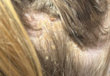 Łojotokowe zapalenie skóry głowy