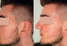 Zastosowanie kwasu azelainowego w redukcji trądziku pospolitego i przebarwień pozapalnych. Opis przypadku