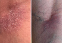 Atopowe zapalenie skóry. Etiopatogeneza, choroby współistniejące i czynniki zaostrzające chorobę