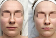 Zastosowanie kwasu laktobionowego oraz glukonolaktonowego w terapii skóry naczyniowej. Opis przypadku