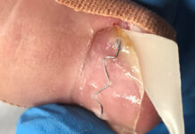 Wykorzystanie kompozytu stomatologicznego w prowadzeniu terapii podologicznych