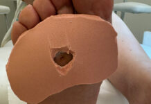 Ortezy silikonowe w profilaktyce zaburzeń stóp