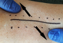 Blizny – efekty terapii manualnej