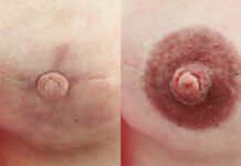 Kosmetologiczne i społeczne problemy w chorobie nowotworowej piersi