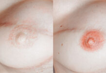 Makijaż permanentny piersi po mastektomii