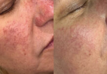 Wykorzystanie termolizy oraz sonoforezy do zamykania naczyń krwionośnych. Opis przypadku