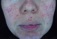 Skóra wrażliwa a naczyniowa – rola wywiadu