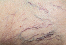 Zmiany naczyniowe – techniki i możliwości ich niwelowania