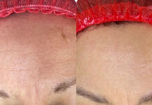 Autologiczne terapie regeneracyjne – potencjał fibryny bogatopłytkowej i osocza bogatopłytkowego