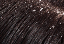 Łupież – przyczyny i rozwiazania problemu