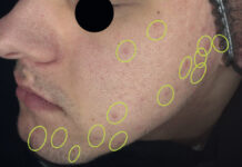 Zastosowanie biomikroigieł krzemionkowych w terapii trądziku. Analiza parametrów skórnych