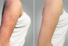 Ocena skuteczności kwasu mlekowego i kwasu migdałowego w terapii rogowacenia okołomieszkowego. Studium przypadku