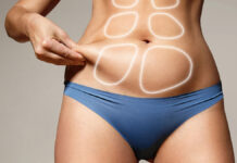 Skuteczność liposukcji kawitacyjnej i fali radiowej w redukcji nadmiernej tkanki tłuszczowej na brzuchu. Badanie pilotażowe