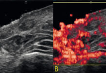 Użyteczność ultrasonografii wysokich częstotliwości w ocenie powikłań po zabiegach estetycznych wykonywanych w dolinie łez. Opis przypadku