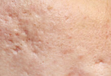 Skuteczność frakcyjnego lasera CO2 w terapii blizn atroficznych potrądzikowych