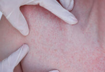 Popromienne zapalenie skóry. Przyczyny, objawy i sposoby pielęgnacji w trakcie radioterapii