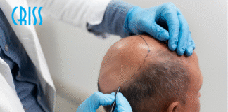 Gwarancja udanego przeszczepu włosów