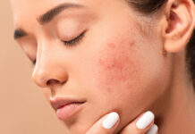 Znaczenie diety w profilaktyce i terapii cery naczyniowej oraz trądziku różowatego