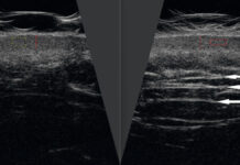 Ocena kliniczna wpływu iniekcji nieusieciowanego kwasu hialuronowego na parametry skóry z oznakami starzenia. Studium przypadku
