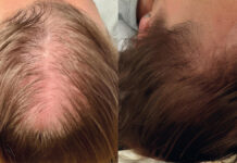 Ocena skuteczności mezoterapii mikroigłowej oraz suplementacji ekstraktem z owoców palmy sabałowej w terapii łysienia androgenowego typu żeńskiego. Studium przypadku