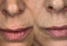 Wpływ masażu liftingującego na kondycję skóry dojrzałej. Studium przypadku